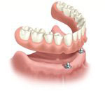 Implant-supported dentures illustration