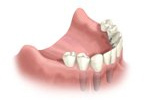 Multiple dental implants illustration