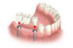 Implant-supported bridge illustration