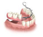 Partial dentures illustration