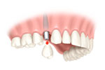 Dental implant illustration